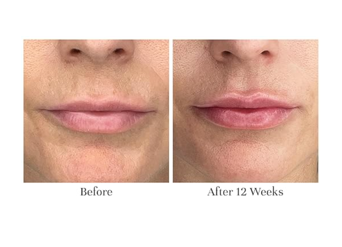 Before and After of City Lips Serum